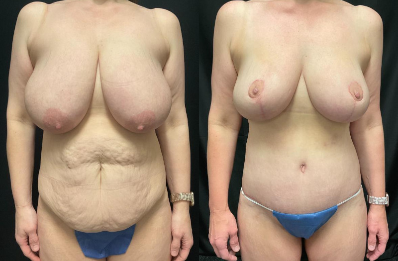 before and after mommy makeover