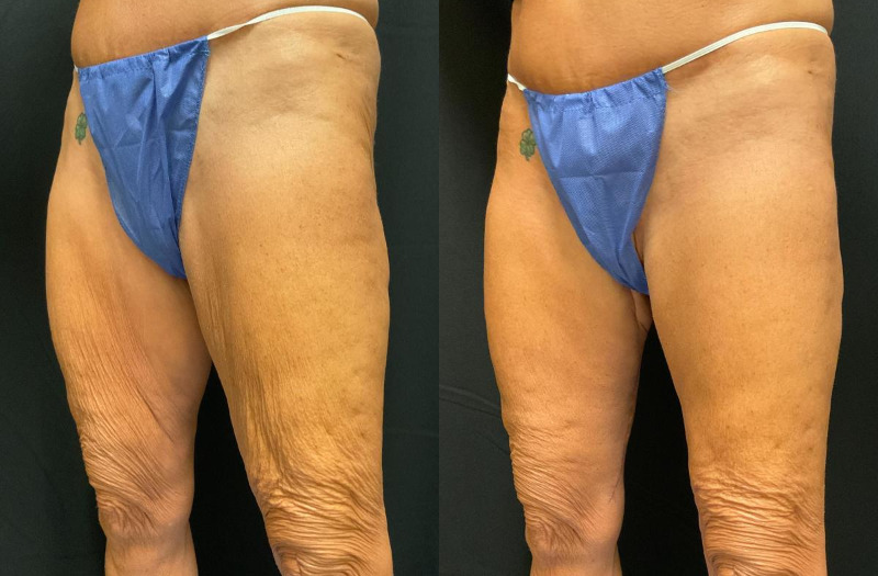 before and after thigh lift