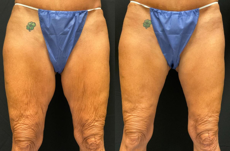 before and after thigh lift