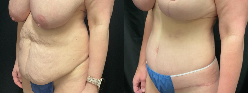 before and after tummy tuck