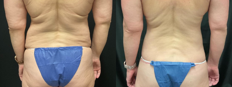 before and after tummy tuck