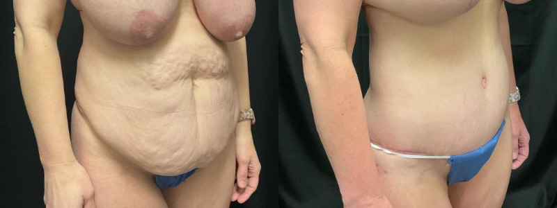 before and after tummy tuck