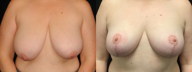 before and after breast augmentation