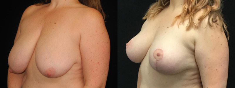 before and after breast augmentation
