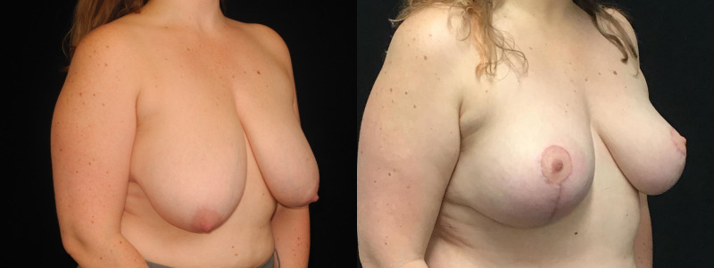 before and after breast augmentation
