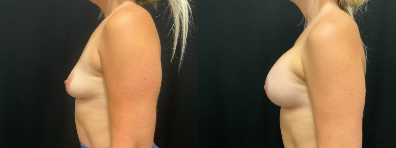 before and after breast augmentation