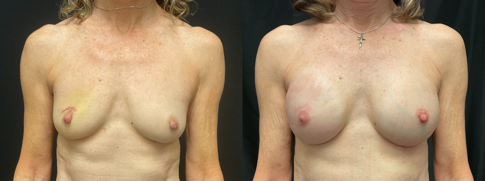 before and after implant reconstruction