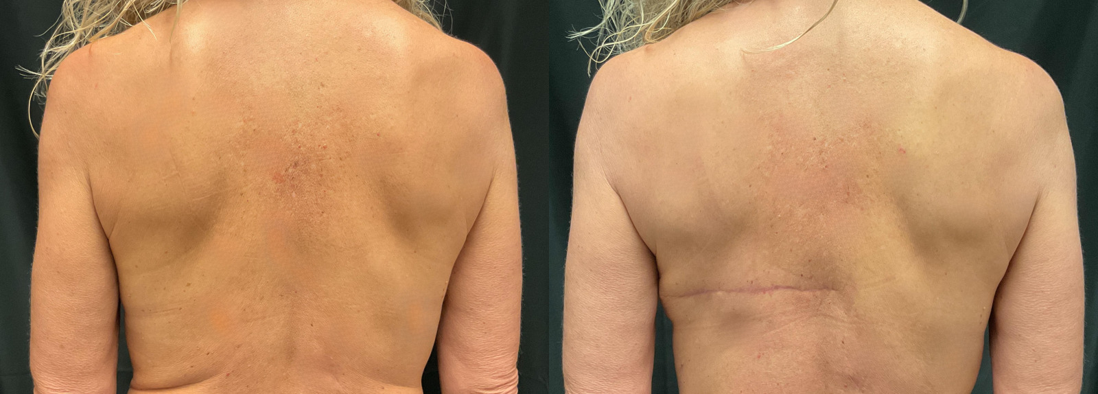 before and after ld flap reconstruction
