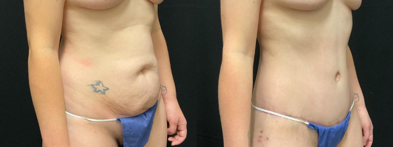 before and after tummy tuck
