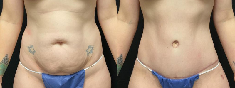 before and after tummy tuck
