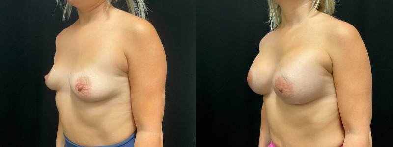 before and after breast augmentation